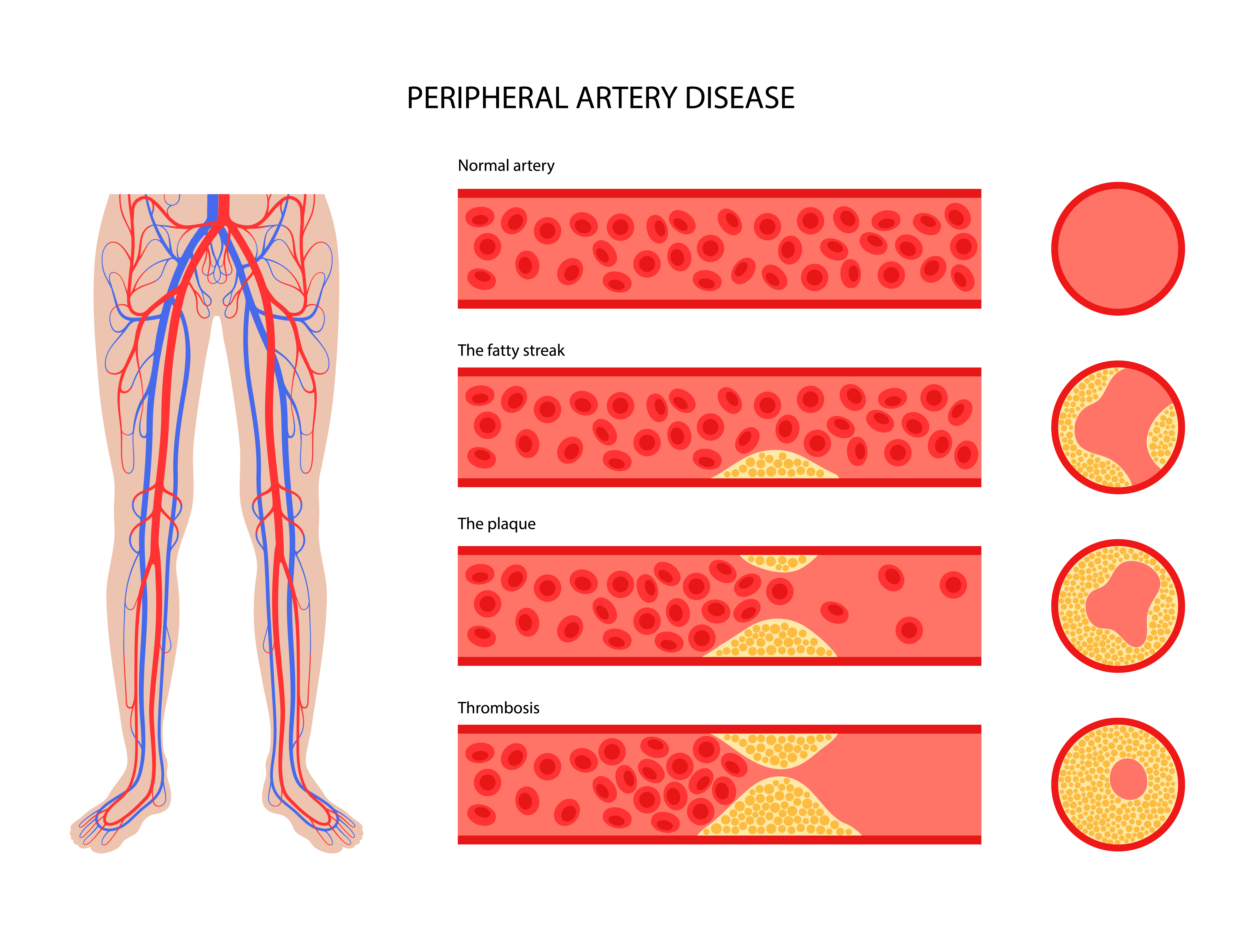 peripheral arterial disease